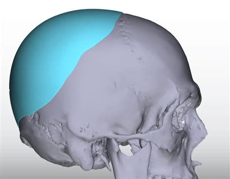 Concepts In Custom Skull Implants For Flat Back Of The Head