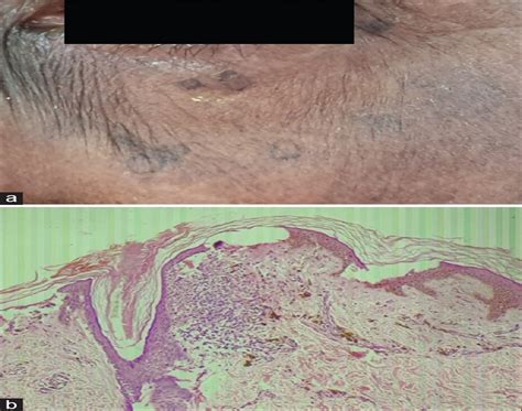 A Case Series Of Disseminated Porokeratosis Clinical Dermatology Review