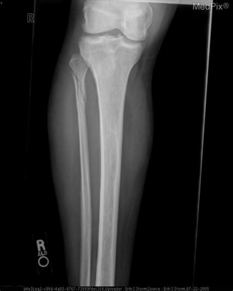 Ap View Of The Proximal Tibia And Fibula Demonstrates A Open I