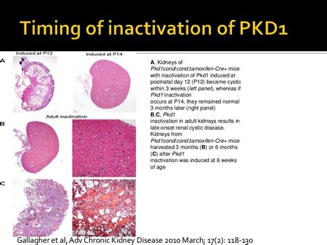 Autosomal Dominant Polycystic Kidney Disease Adpkd