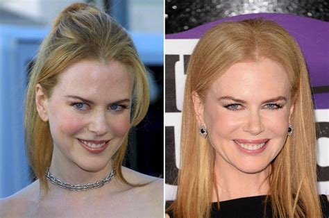 Nicole Kidman In 2001 Left And In 2013 Right Nicole Kidman Lip