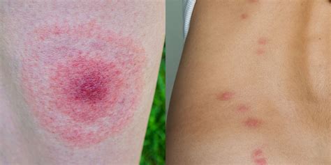These Pictures Will Help You Id The Most Common Bug Bites And Their Symptoms Artofit