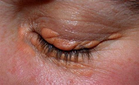 Eyelid Lumps And Bumps Eye Plastic Surgery Of Minneso Vrogue Co