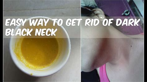 Home Remedies For Dark Neck Get Rid Of Black Neck In 20 Minutes In