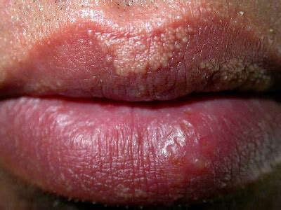 How To Deal With Fordyce Spot On The Lips New Health Advisor