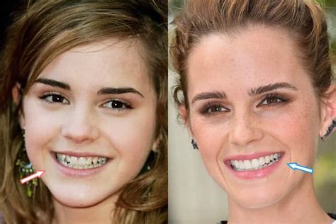 Emma Watson Cosmetic Surgery Nose Job Teeth And Breast Implants