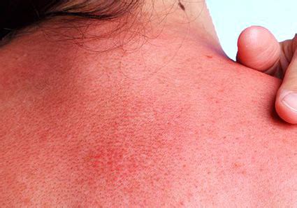 It hurts, it burns, it stings, it peels. Top Homeopathic Treatment for Sunburn - Homeopathy at ...