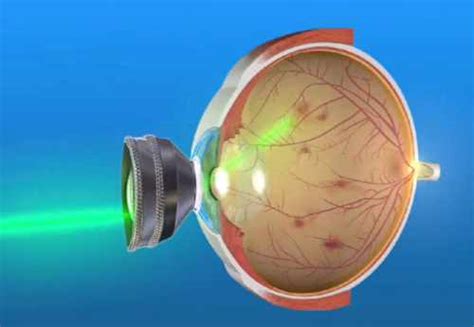 Retinal Laser Photocoagulation Purpose Procedure Risks