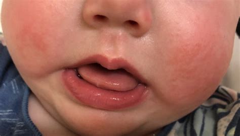 Face Rash Teething Or Allergy August 2017 Babycenter Australia
