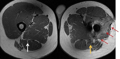 Peripheral Nerve Imaging Hawaii Diagnostic Radiology Services By Yandm