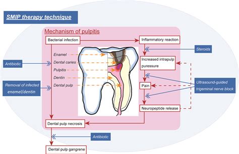 Cureus Maintaining Tooth Vitality With Super Minimally Invasive Pulp