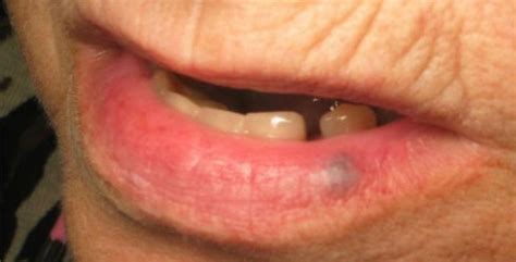 Laser Dentistry Clinton Township Mi Removing Dark Spots On Lip