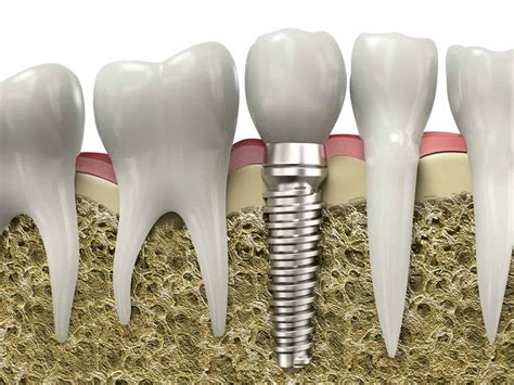 Your Dental Implants Cost Explained