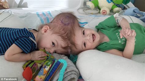 Moment Twins Conjoined At The Head Look At Each Other For The First