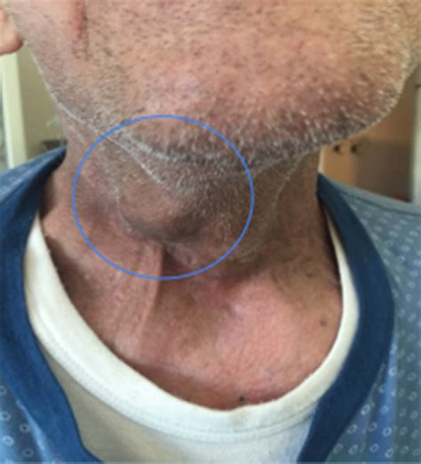 Pulsatile Neck Mass In A Man After Hemiglossopelvectomy With
