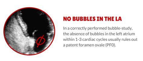 4 Things Needed To Rule Out A Patent Foramen Ovale Pfo Cardioserv
