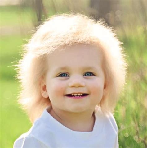 This Adorable Toddler Has Uncombable Hair Syndrome And Its A Rare