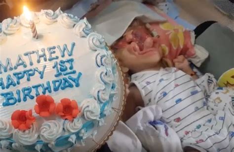 Baby Born Without Face Defies All Odds To Celebrate His First Birthday