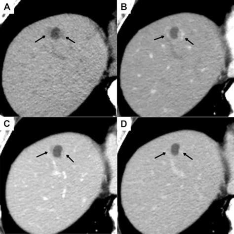 Initial Dynamic Contrast Enhanced Computed Tomography Ct A Small