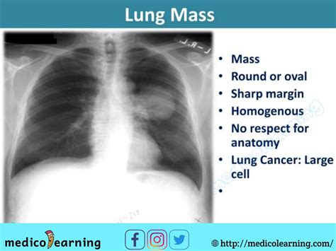 Lung Mass Medical Radiography Medical Pictures Radiology Imaging