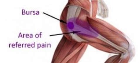 Trochanteric Hip Bursitis Is An Overuse Injury At The Hip Joint Caused