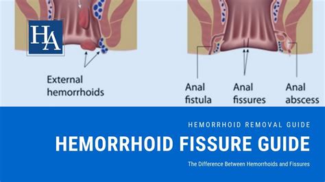 Hemorrhoid Fissure Guide The Difference Between Hemorrhoids And Fissures Youtube