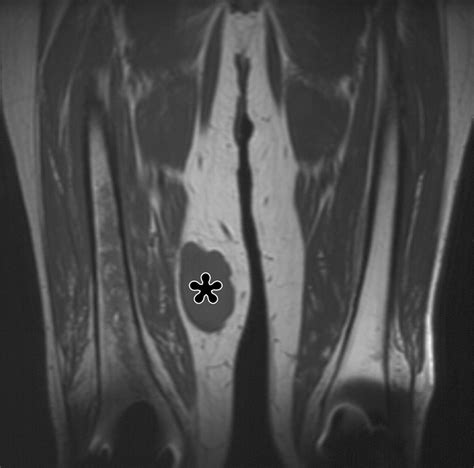 Imaging Of Musculoskeletal Liposarcoma With Radiologic Pathologic