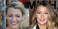 Blake Lively's Nose Job Surgery: Face Before and After