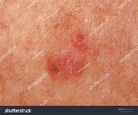 Case Actinic Keratosis Solar Keratosis Stock Photo 1347765152