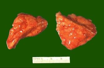 The Adrenal Glands - Caring for Clients with Disorders of the Endocrine