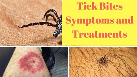 Tick Bite Pictures Symptoms Causes Treatment Hubpages