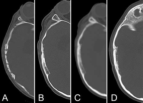 Axial Cts Of The Right Temporal Bone Slices At The Same Level At 2