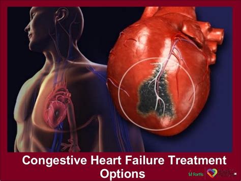 Advanced Heart Failure Treatment Options