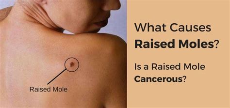 Raised Mole Is It Cancerous All You Need To Know About Raised Moles