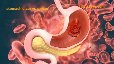 Surgery For Stomach Ulcer Everything You Need To Know