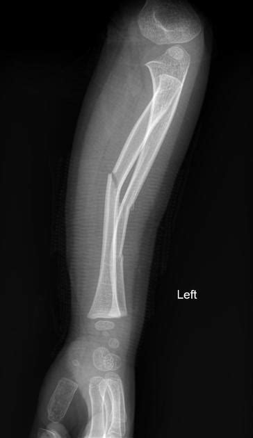 Cortical Buckle Fracture Pacs