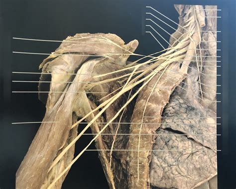 Brachial Plexus Cadaver Diagram Quizlet