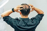 【男士脫髮】甚麼是男性型脫髮？附上7大解決方法 | Perfect Men