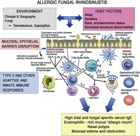 Allergic Fungal Rhinosinusitis Journal Of Allergy And Clinical Immunology