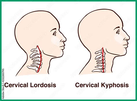 Normal Vs Reversal Of Cervical Lordosis Stock Vektorgrafik Adobe Stock