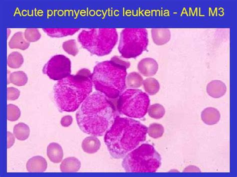 Acute Myeloid Leukemia What Is An Acute