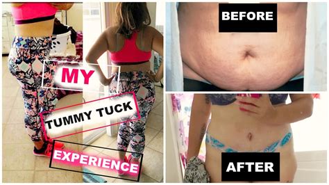 MY WEIGHT LOSS JOURNEY TUMMY TUCK EXPERIENCE BEFORE AND AFTER PICS