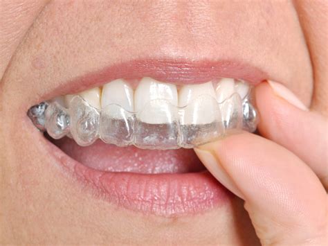 What Is The Success Rate Of Invisalign