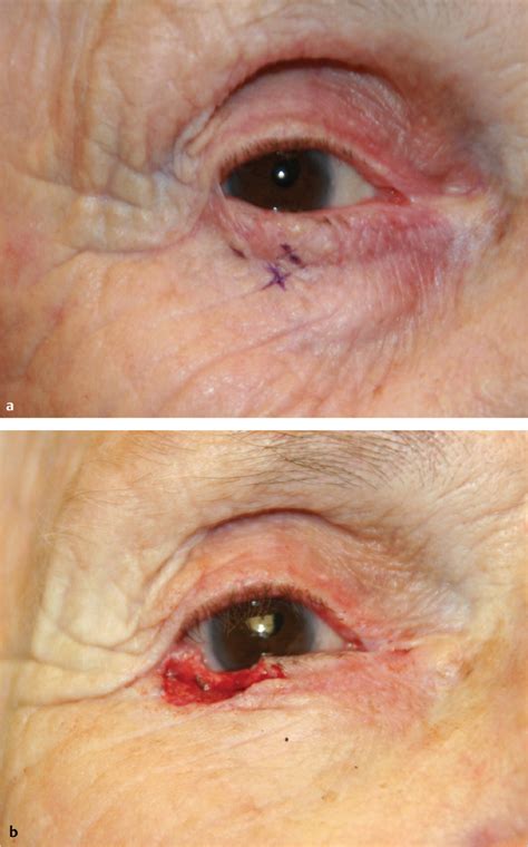 Eyelid Cancer And Reconstruction Plastic Surgery Key