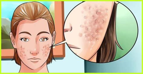 Acne And Blemishes Dr Health Clinic Homepage