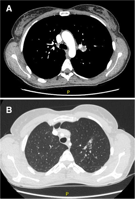 Atypical Bronchial Carcinoid With Postobstructive Mycobacterial