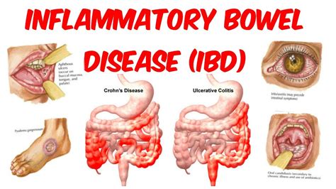 Inflammatory Bowel Disease Ibd Symptoms Causes 58 Off