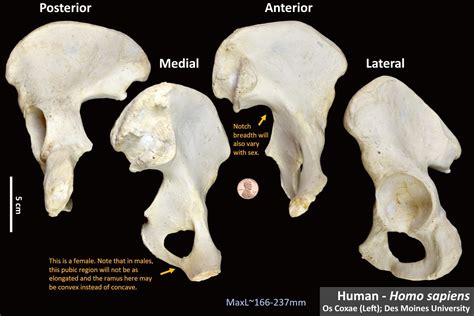 Human Os Coxae Osteoid Bone Identification
