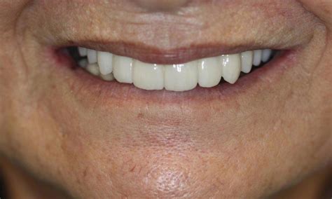 Full Dental Implants Smile Gallery Darwin Dentist