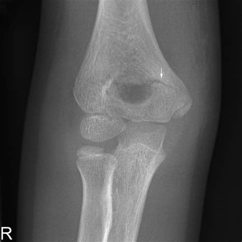 Elbow Supracondylar Fracture Cases Wikiradiography